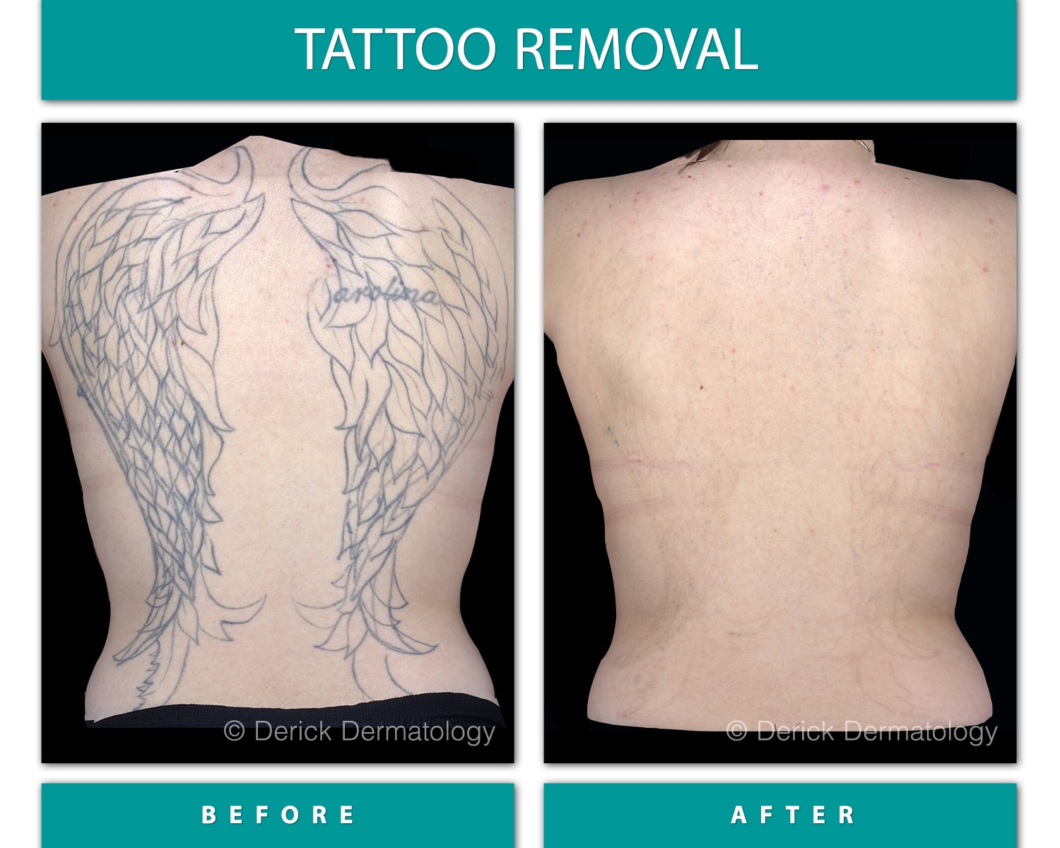 Before and After Image of Tattoo Removal